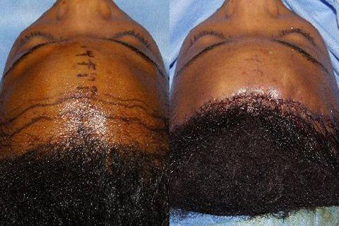 Hair Line Lowering before and after photos in San Francisco, CA, Patient 14233