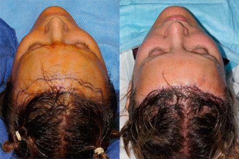 Hair Line Lowering before and after photos in San Francisco, CA, Patient 14244