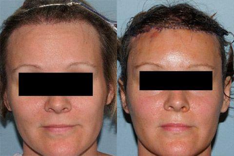 Hair Line Lowering before and after photos in San Francisco, CA, Patient 14244