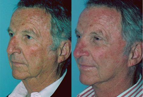 Facelift before and after photos in San Francisco, CA, Patient 14605